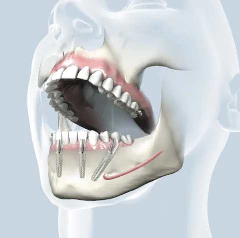 Bild: Zahnimplantate: Feste Zähne sofort