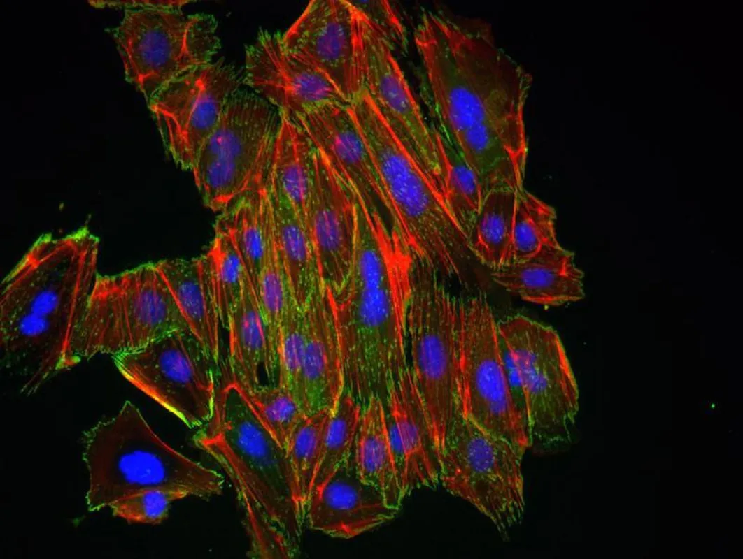 Epitheliale Brustkrebszellen nach der Behandlung mit einem EMT-Auslöser. (Universität Basel, Department Biomedizin)