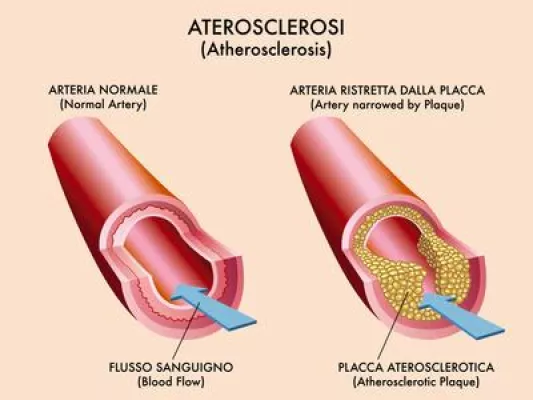 Bild: Zu hohe Cholesterin Werte – Abhilfe durch Personal Fitness Training