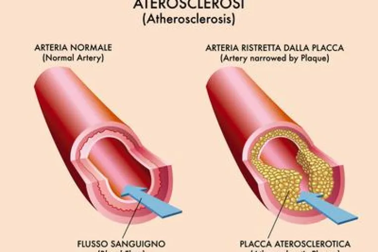 Bild: Zu hohe Cholesterin Werte – Abhilfe durch Personal Fitness Training