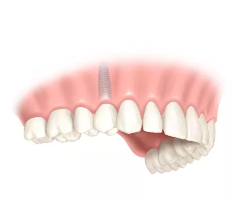 Bild: Beliebter Lückenfüller - Bei Zahnlücken bieten Implantate viele Vorteile