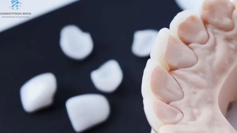 Zahnarzt Nekzai: Ein schönes Lächeln mit Veneers und Lumineers Bild: Zahnarzt Nekzai: Ein schönes Lächeln mit Veneers und Lumineers