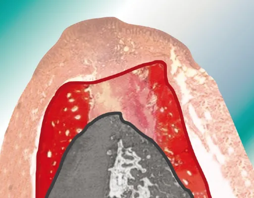 Bild: Kollagenvlies: Knochen erhalten – ästhetisch und erfolgreich implantieren