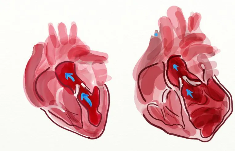 Bild: Studie an transplantierten Herzen gibt Risikogene für Herz-Kreislauf-Erkrankungen preis