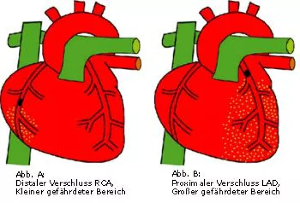Bild: corpuls® stellt einen neuen EKG-Interpretations-Algorithmus vor, der die Diagnosefindung bei Patienten mit akuten Brustschmerzen verbessert