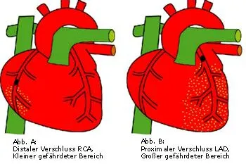 Bild: corpuls® stellt einen neuen EKG-Interpretations-Algorithmus vor, der die Diagnosefindung bei Patienten mit akuten Brustschmerzen verbessert