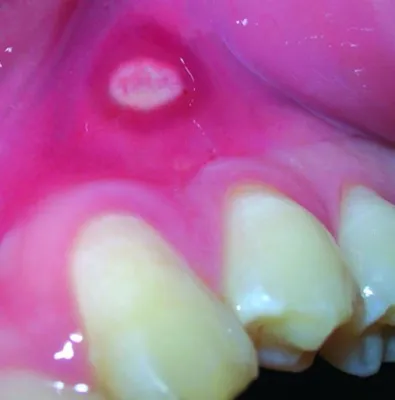 Bild: Sinaftin® - Die schwedische Innovation gegen Aphthen