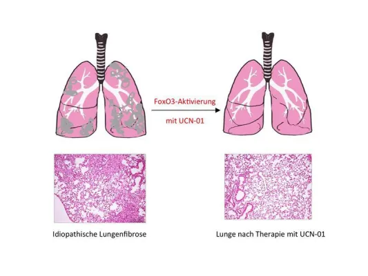Bild: Einzelner Transkriptionsfaktor für idiopathische Lungenfibrose verantwortlich