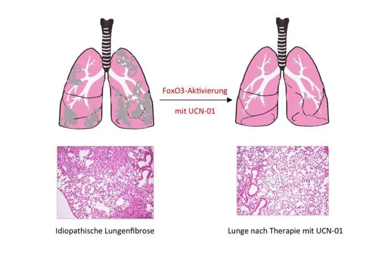 Einzelner Transkriptionsfaktor für idiopathische Lungenfibrose verantwortlich Bild: Einzelner Transkriptionsfaktor für idiopathische Lungenfibrose verantwortlich