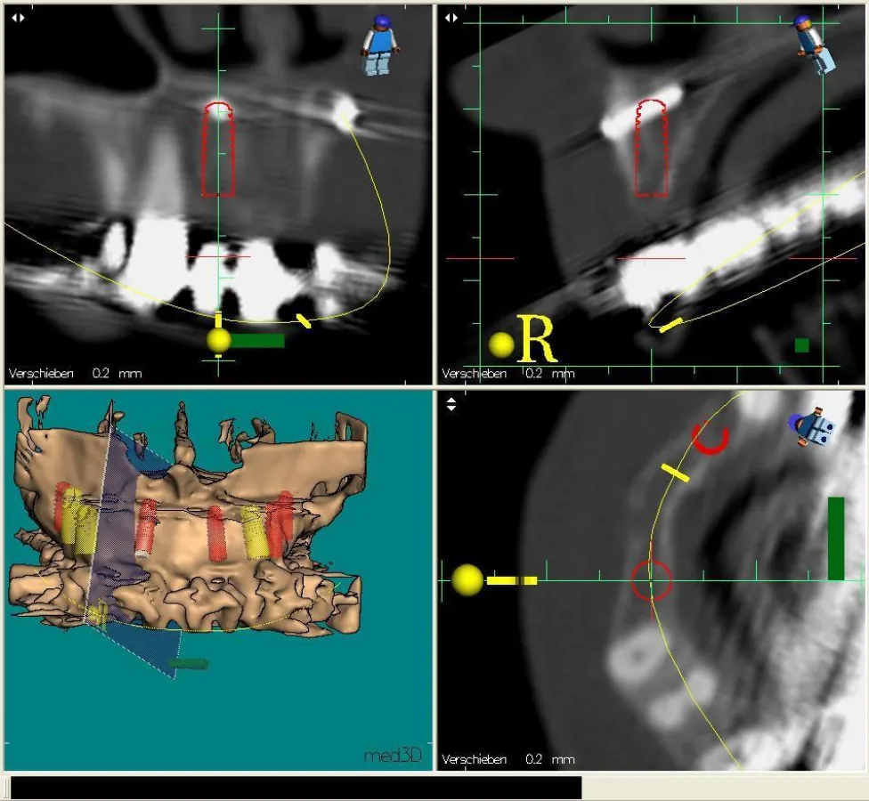 Darstellung der geplanten Implantation im Planungsprogramm