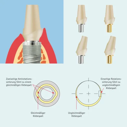 Bild: SKY Zirkonabutment – mehr Ästhetik, mehr Wirtschaftlichkeit, weniger Aufwand