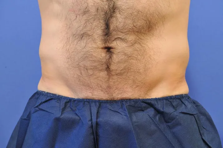 Bild: Pölsterchen adé - revolutionäre Methode legt „Love-Handles“ auf Eis