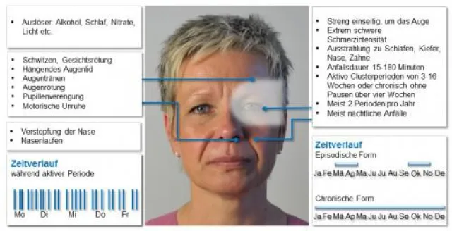 Bild: Neue Studie zur Entstehung von Clusterkopfschmerzen