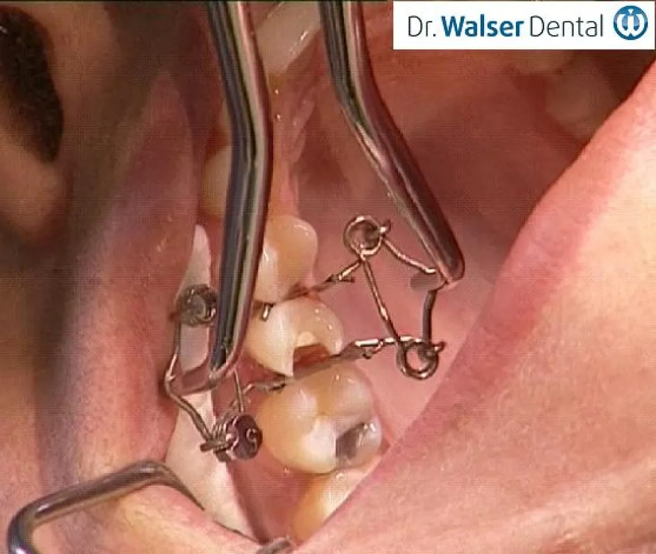 Walser Teilmatrizensystem/Foto: Dr. Walser Dental