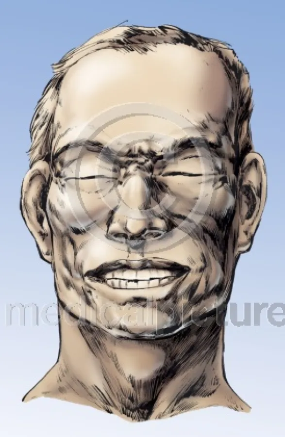 Risus sardonicus, der Wundstarrkrampf im Bild