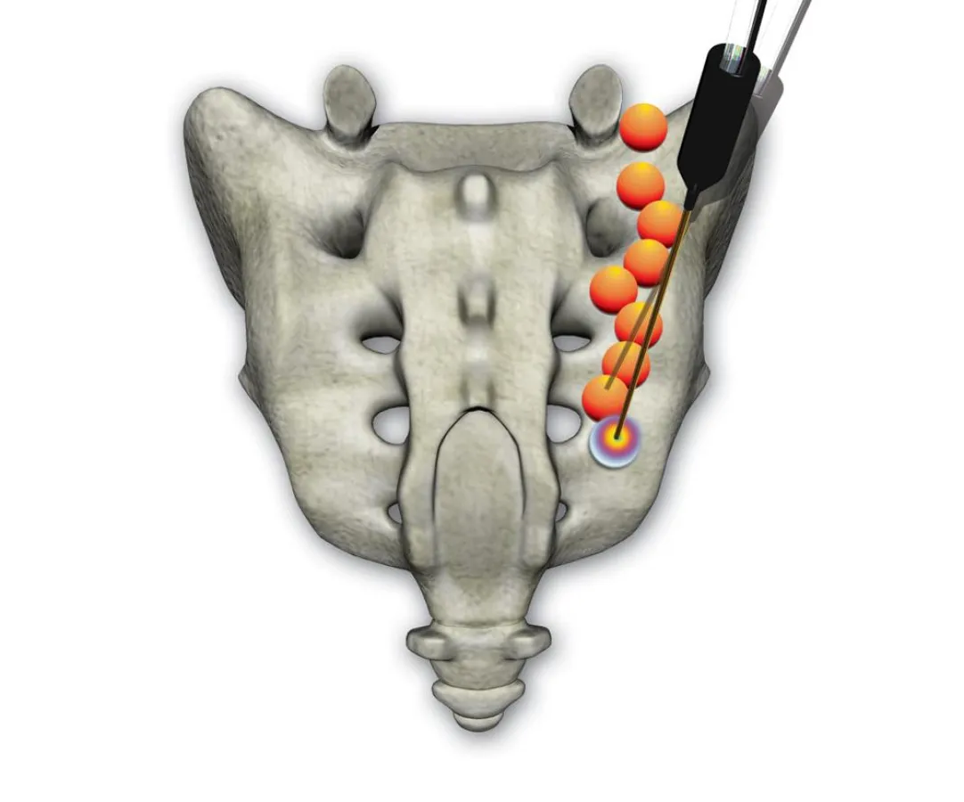 Die wassergekühlte Sonde verödet den markierten Schmerznerv.