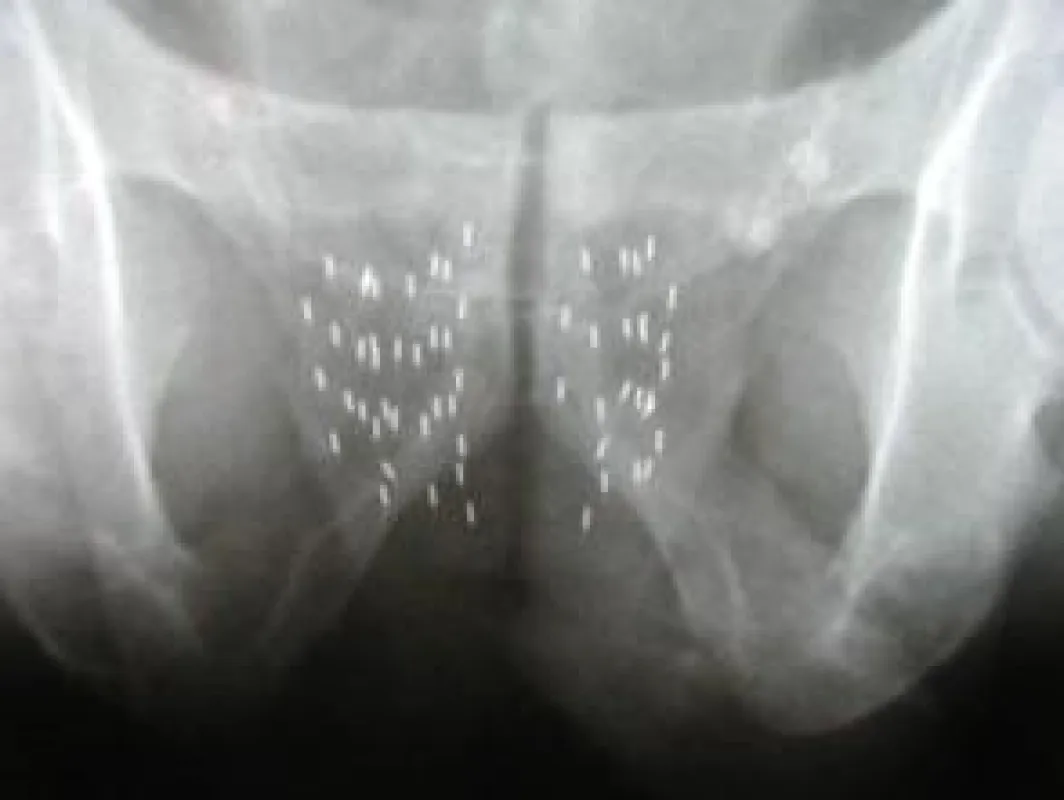 Röntgenaufnahme zeigt die präzise Verteilung der Seeds in der Prostata