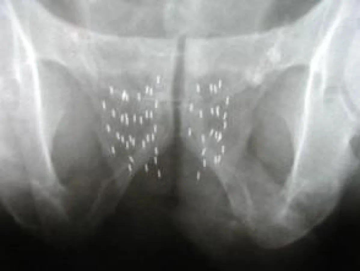 Röntgenaufnahme zeigt die präzise Verteilung der Seeds in der Prostata