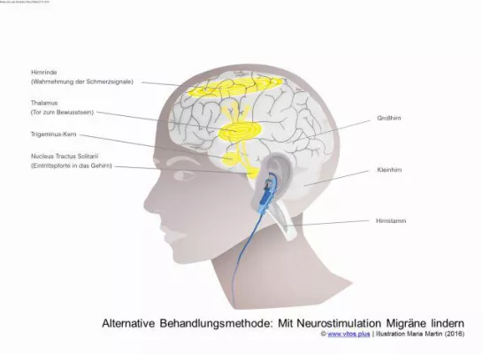 Bild: Neues aus der Forschung: Migräne mit Neurostimulation lindern