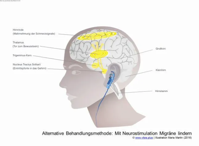 Neues aus der Forschung: Migräne mit Neurostimulation lindern Bild: Neues aus der Forschung: Migräne mit Neurostimulation lindern