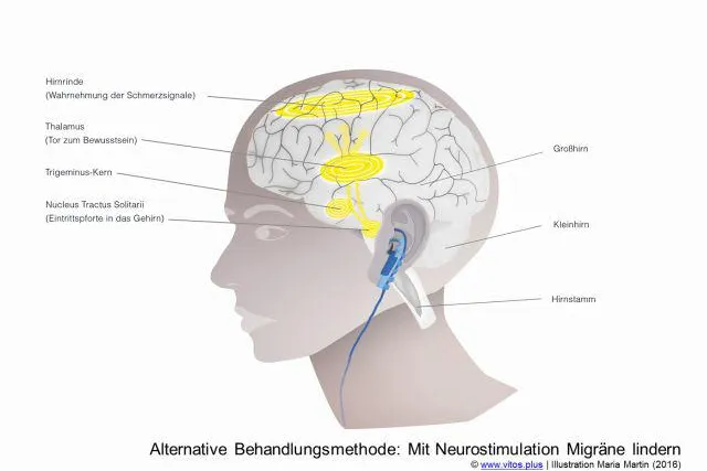 Bild: Neues aus der Forschung: Migräne mit Neurostimulation lindern