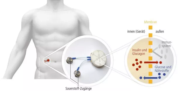 Bild: Diabetes: Transplantation tierischer Inselzellen ohne Eingriff ins Immunsystem rückt näher