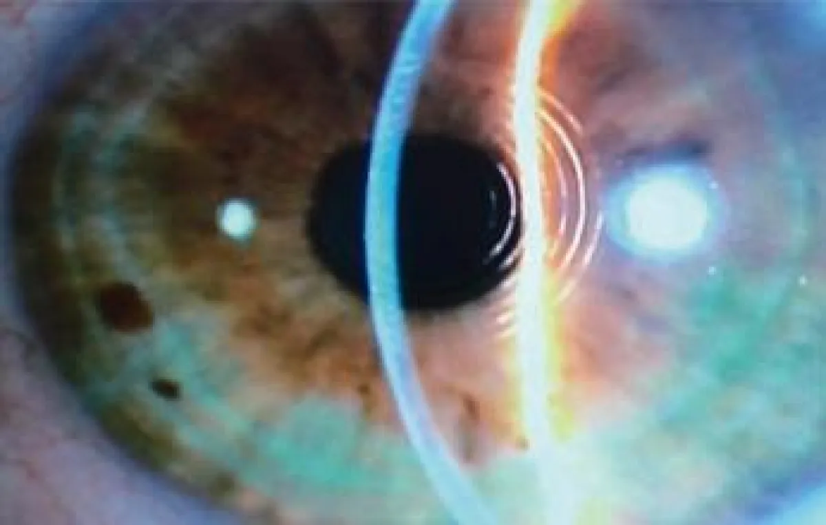 Aufnahme eines behandelten Auges einen Tag nach der Operation. Gut erkennbar: die feinen Ringmuster in der Hornhaut durch die Behandlung mit dem Femtosekunden-Laser.