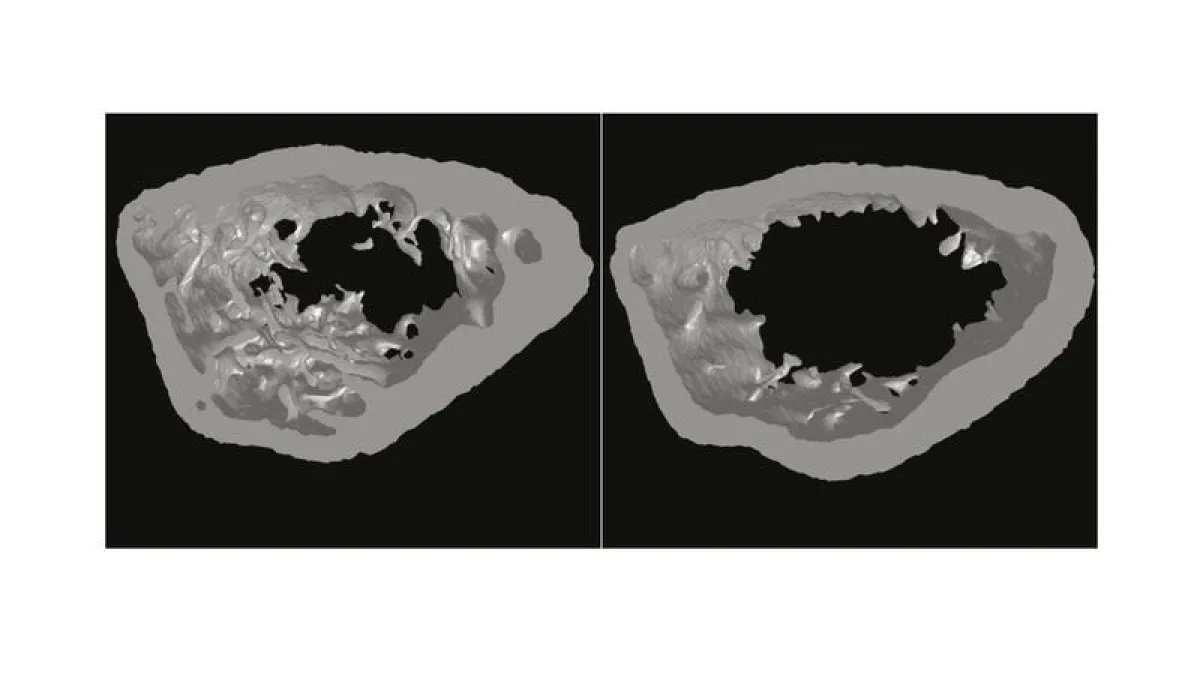 Figur Osteoporose (Aufnahme: Institut für molekulare Endokrinologie)