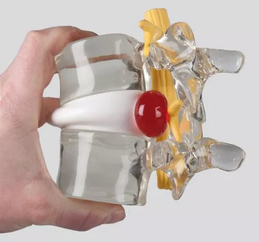 Bild: Bandscheiben-Vorfall – richtig erkennen, verstehen und behandeln