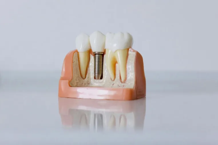 Bild: Innovative Keramik-Implantate - Natürlich schön, langlebig und biokompatibel