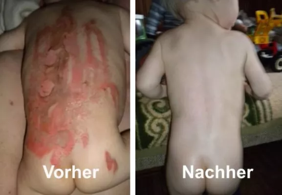 Bild: Durch Wundheilmittel können Hauttransplantationen bei Verbrennungen und Verbrühungen vermieden werden