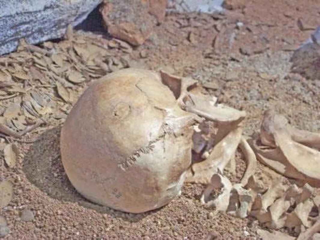 Unglaublich: Knochentransplantation vor 4000 Jahren!