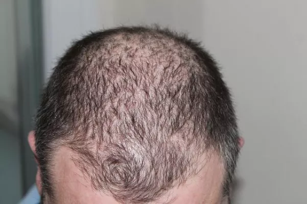 Bild: Welche Ursachen für Haarausfall gibt es?