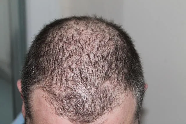 Bild: Welche Ursachen für Haarausfall gibt es?
