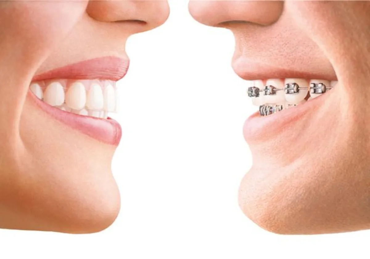 links: Invisalign; rechts: konventionelle feste Zahnspange