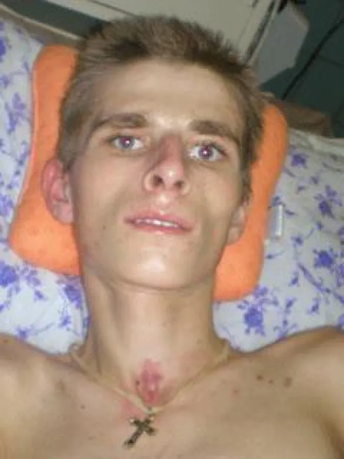 Dem Rekruten Roman Kasakow wurde in der Einheit 02511 in Kamenka die Schädeldecke eingeschlagen, danach versuchte man, ihn mit Abgasen zu vergiften. Bild: Soldatenmütter St. Petersburgs