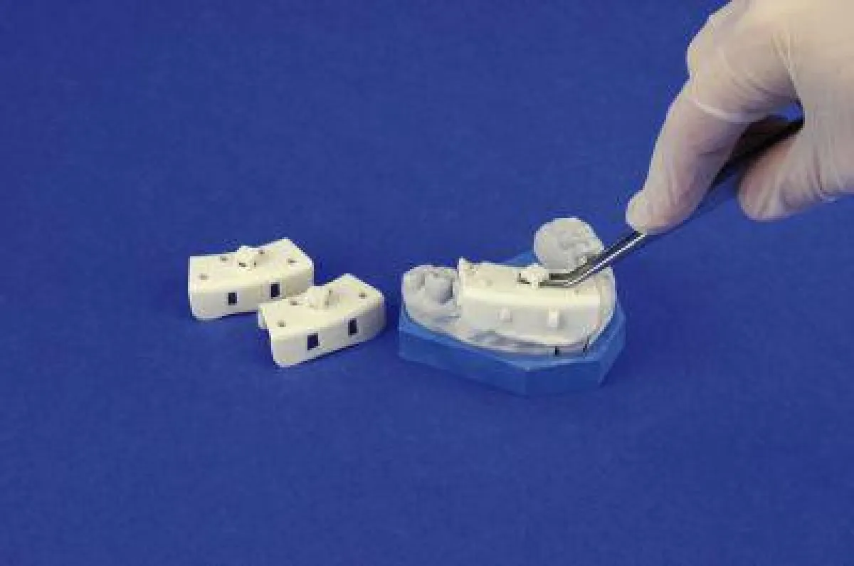 Miratray®-Minis lassen sich in allen Quadranten zur partiellen Teilabformung einsetzen.