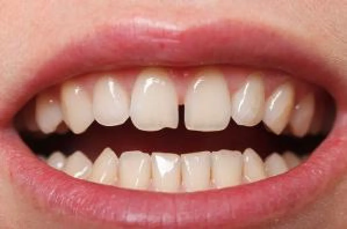 Ein sogenanntes mediales Diastema - schick oder scheußlich?