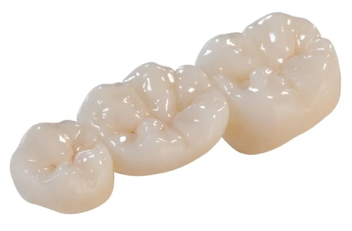 Bild: Optimale Zahnversorgung für Knirscher und Bruxer