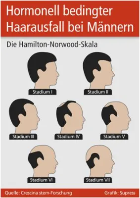 Bild: Hormonell bedingter Haarausfall bei Männern
