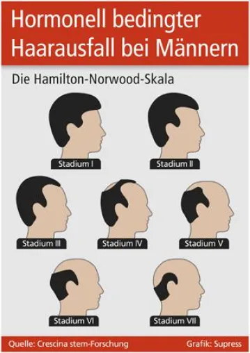 Hormonell bedingter Haarausfall bei Männern Bild: Hormonell bedingter Haarausfall bei Männern