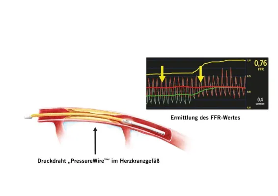 Bild: Koronare Herzerkrankung: Vor der Stent-Implantation kommt die Druckdrahtmessung