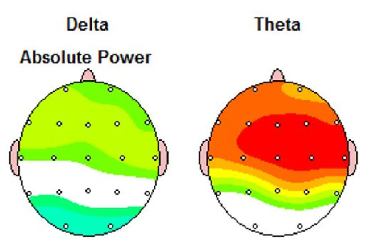 Brainmapping-Aufnahme. Gelb, grün und rot markerien hohe Abweichungen