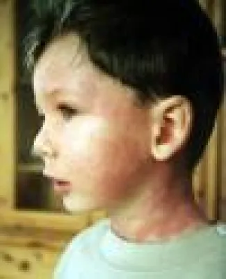 Bild: Neue Möglichkeiten zur Heilung von Allergien