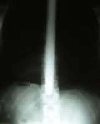 Bild: Schwertschlucken - Was Sodbrennen-Patienten daraus lernen