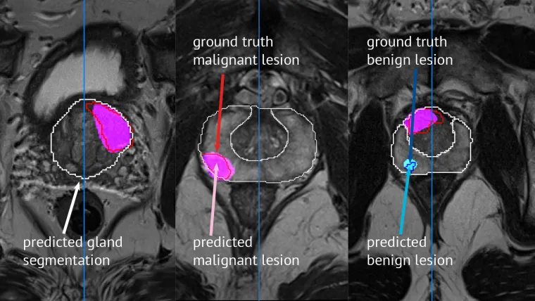 Bild: KI-Software vom Hamburger Start-up FUSE-AI hat Premiere auf der RSNA in Chicago