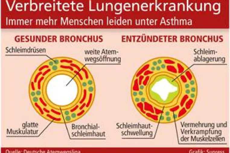 Verbreitete Lungenerkrankung Bild: Verbreitete Lungenerkrankung