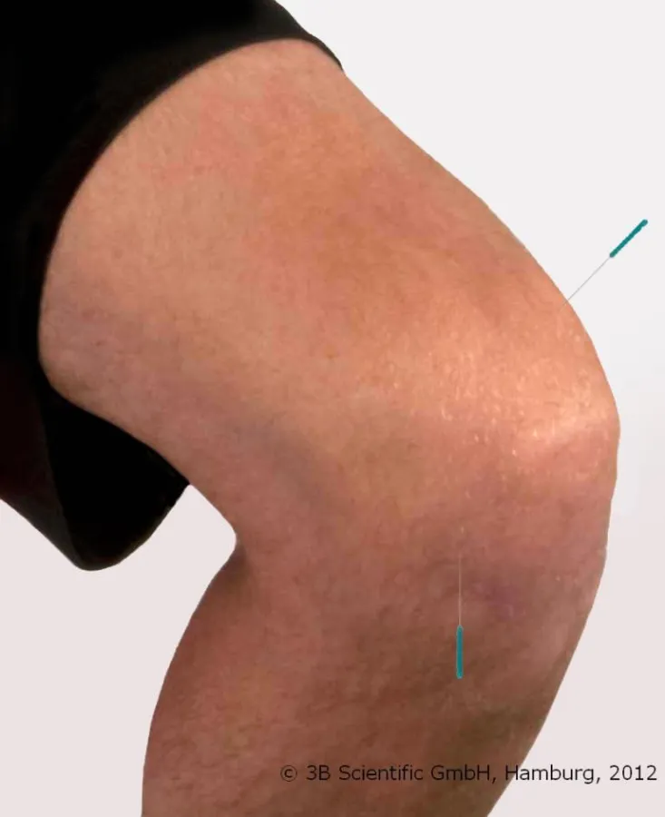 Sanfte und effektive Akupunktur: SEIRIN® J-Typ, erhältlich bei 3B Scientific