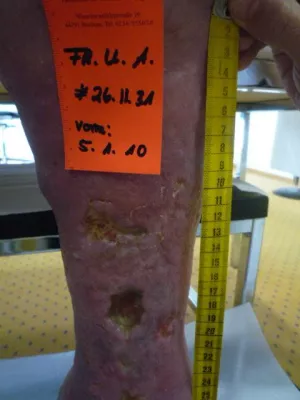 Bild: Offene Beine-oft ein Drama , das nicht sein müsste! Hautverpflanzung unnötig