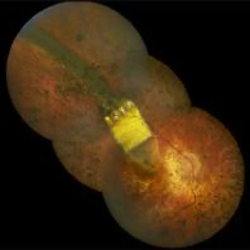 Blick durch die Pupille: Das Retina-Implantat im menschlichen Auge.